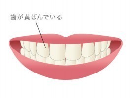 Fapホワイトニングの治療方法 内村歯科医院 蓮田市